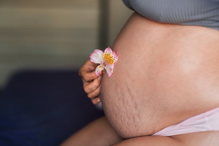 stretch marks saat hamil, cara menghilangkan stretch marks, stretch marks trimester ketiga, krim stretch mark aman untuk ibu hamil, perawatan kulit ibu hamil, tips mencegah stretch marks alami